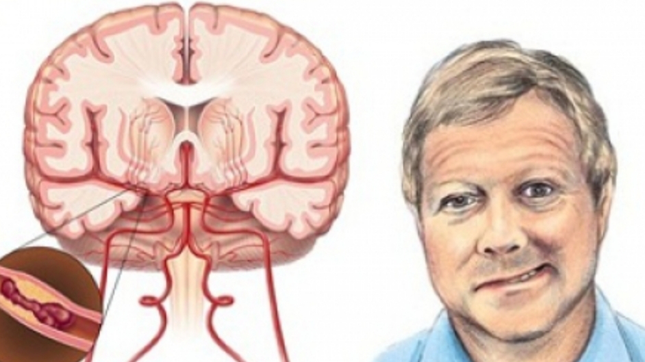 Pusing Mendadak, Penglihatan Kabur, Tubuh Lemas, Waspada Gejala Dini Stroke!    