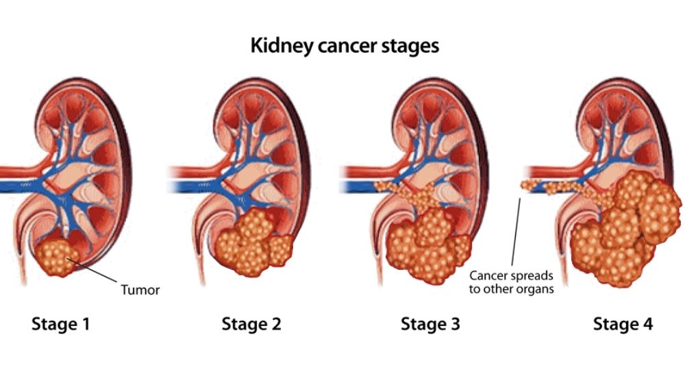 Kanker Ginjal di Usia Muda, Kasus Vidi Aldiano Jadi Pengingat Pentingnya Deteksi Dini