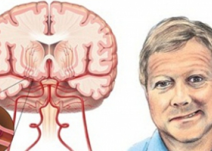 Pusing Mendadak, Penglihatan Kabur, Tubuh Lemas, Waspada Gejala Dini Stroke!    