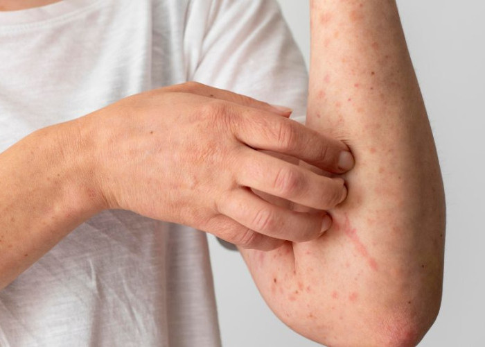 Jangan Dianggap Flu Biasa, Ini Gejala Awal Campak yang Mirip Flu