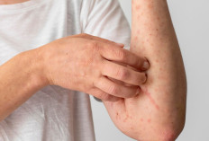 Jangan Dianggap Flu Biasa, Ini Gejala Awal Campak yang Mirip Flu