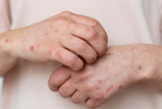 Jangan Salah Kira, Ini Perbedaan Campak dan Cacar Air